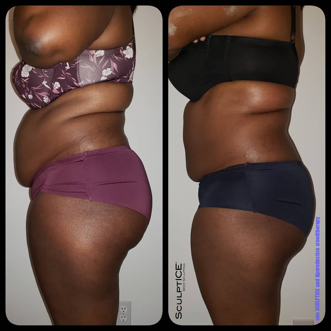 Non Invasive Body Sculpting