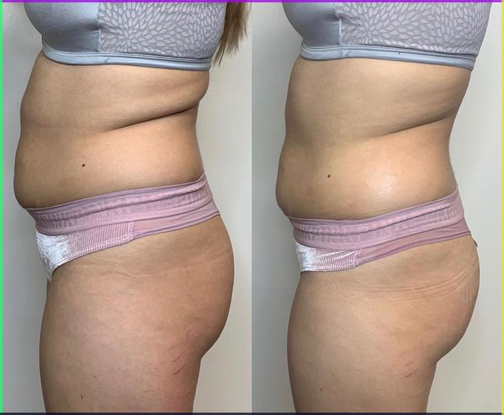 Non Invasive Body Sculpting