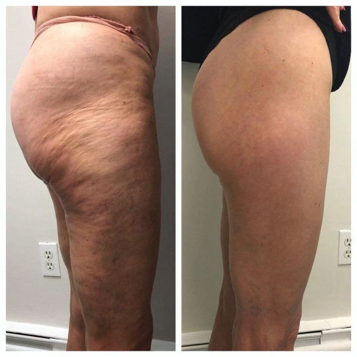 Non Invasive Body Sculpting