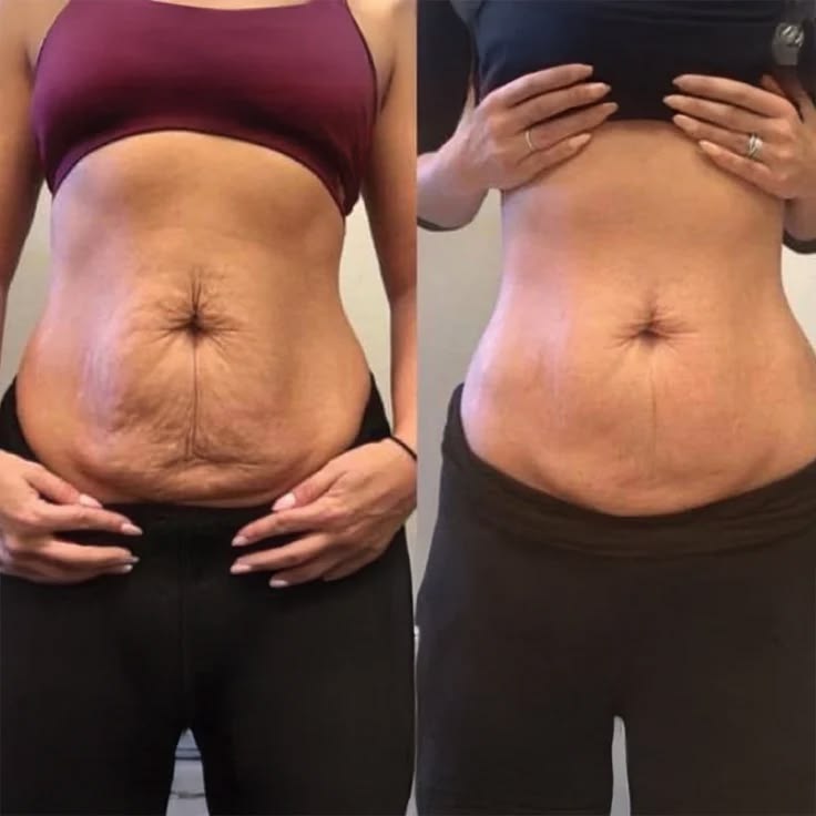 Non Invasive Body Sculpting